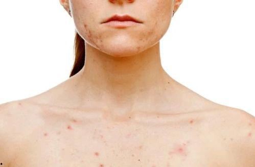女性胸前长斑图片,成因与护理攻略